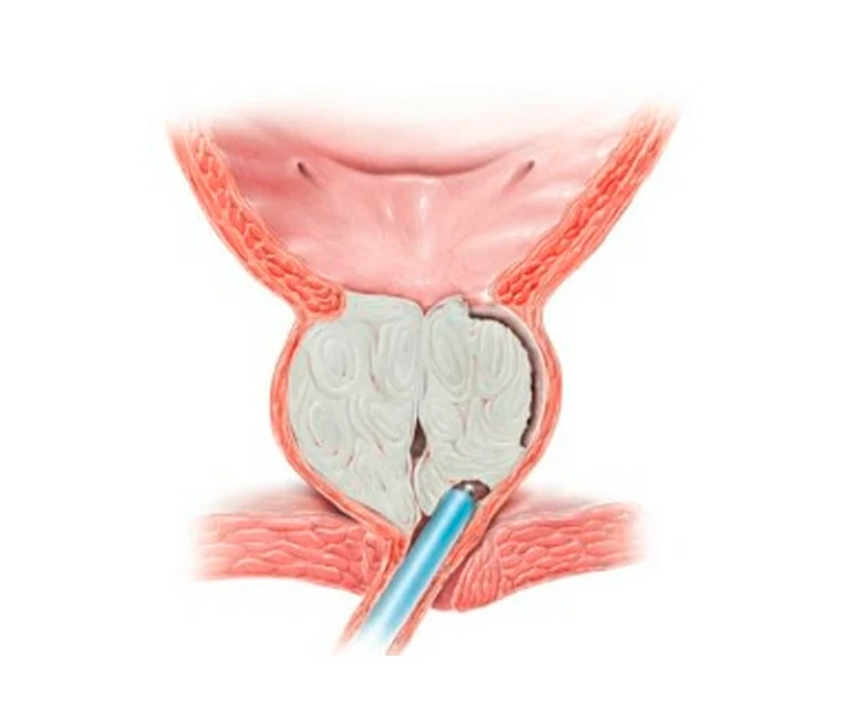 Enucleacion de próstata con láser de holmio (HoLEP) enucleacion de prpstata con laser de holmio holep