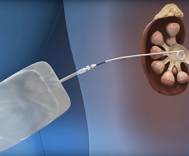 Nefrolitotomía percutánea Nefrolitotomia percutanea