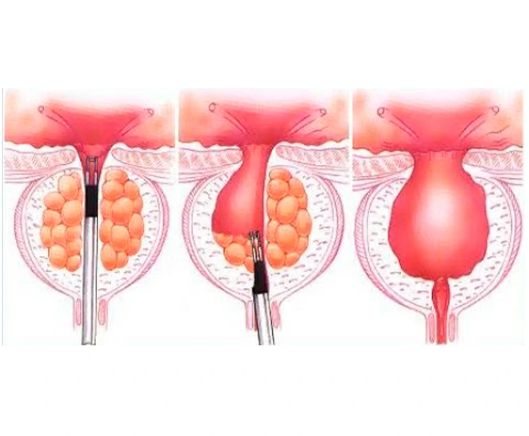 Resección transuretral de próstata bipolar reseccion transuretral de prostata bipolar