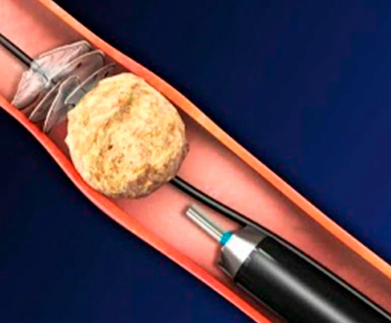 ureterolitotricia semirrigida laser