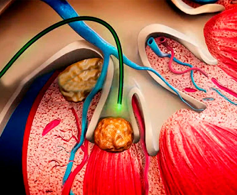 Ureterorrenoscopia flexible láser ureterorrenoscopia flexible laser