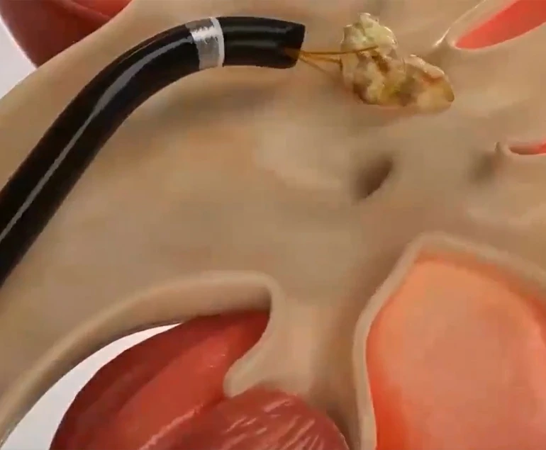 Uretrolitotricia láser uretrolitotricia laser